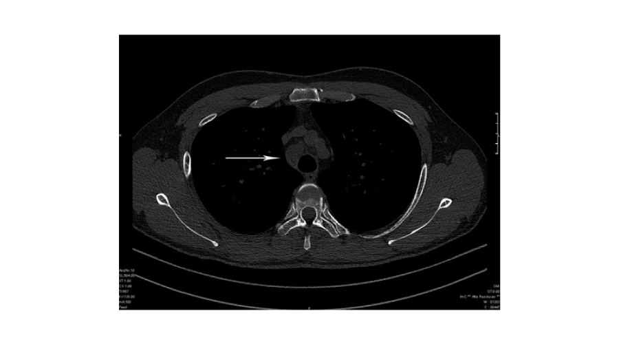 High Resolution Ct Showing Enlarged Paratracheal Lymph Nodes Arrow