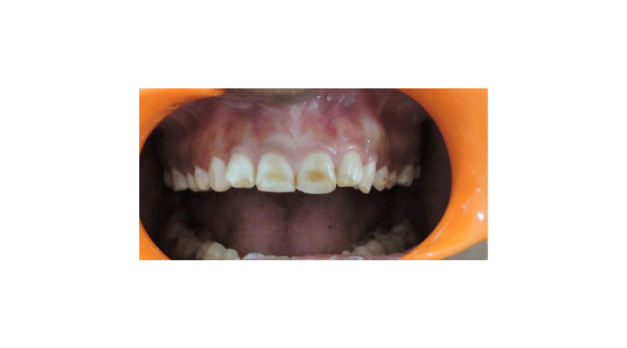 Preoperative intraoral frontal view.