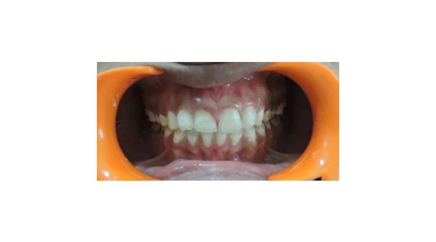 Intraoperative view minimal enamel preparation.