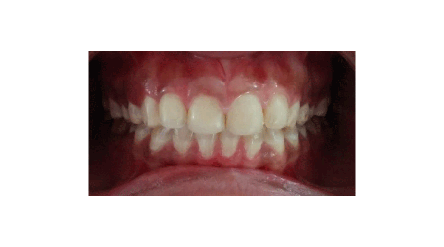 Postoperative frontal view.