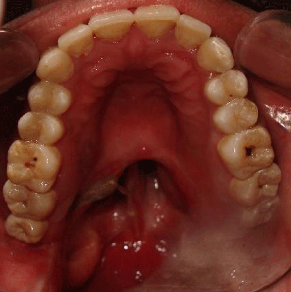 Intra oral view of resected soft palate.