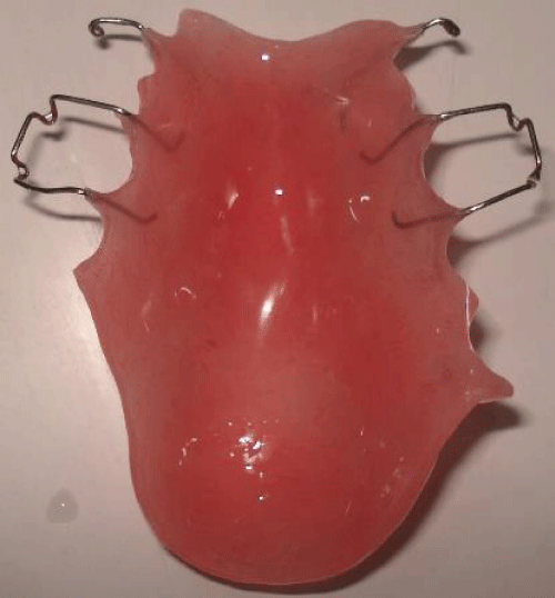 Intaglio surface of Obturator prosthesis.