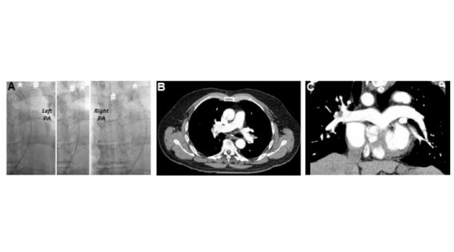 Bilateral staged USAT achieved with the use of the same thrombolysis