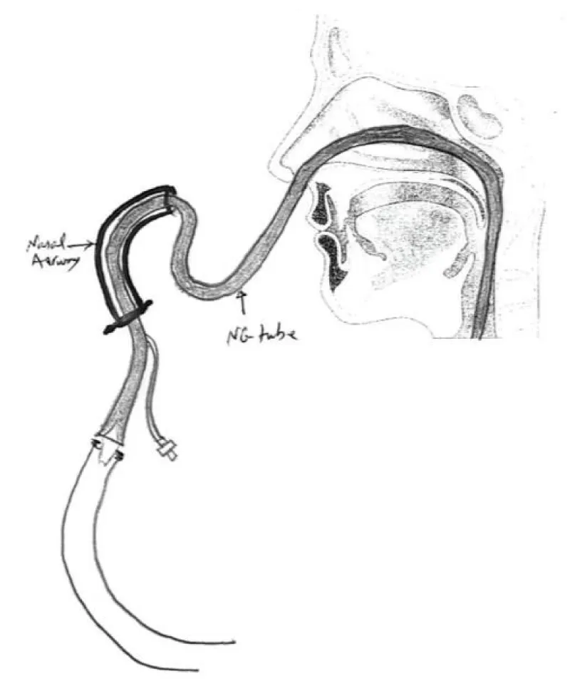 A new method of placing nasogastric tubes in patients at high risk of
