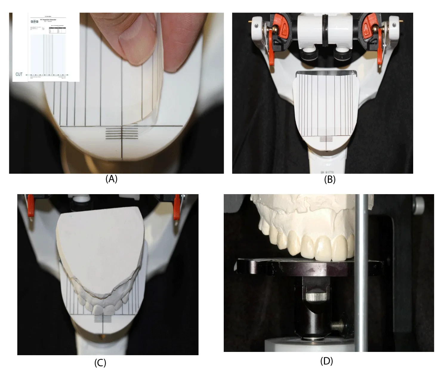 Aesthetic and functional smile enhancement using digital occlusion