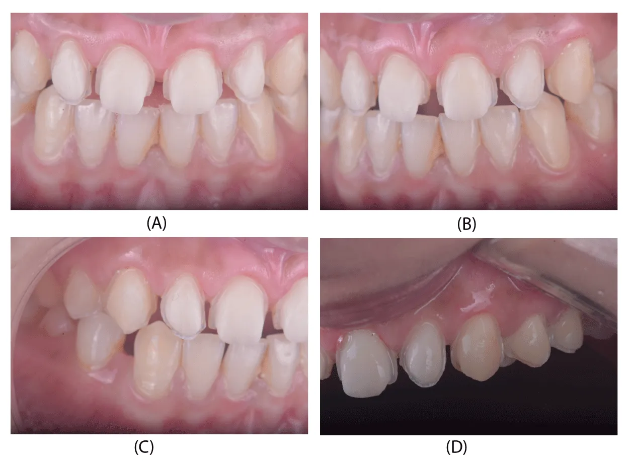 Aesthetic and functional smile enhancement using digital occlusion