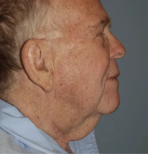 The extended modified male Zplasty necklift for correction of severe
