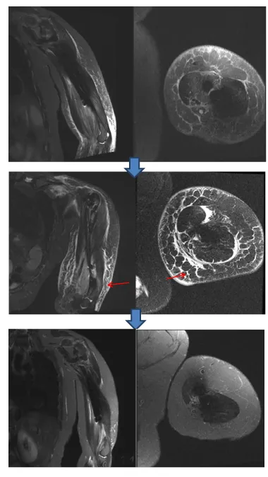Radiation Recall Masquerading as an Infectious Process