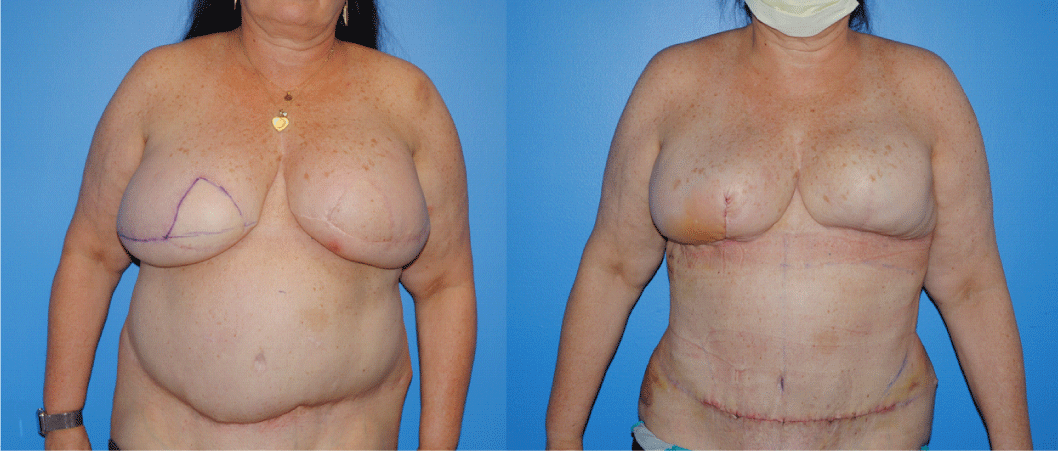 Bilateral DIEP Flap Breast Reconstruction - Brian P. Dickinson M.D.