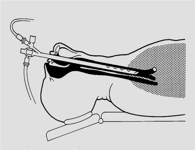 Temporomandibular Joint Movements during Rigid Bronchoscopy and