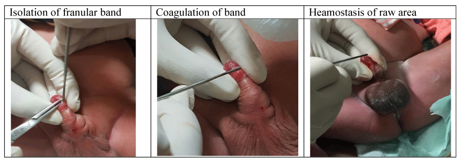 RHCG - Information about Infant (New-born) Plastibell Circumcision