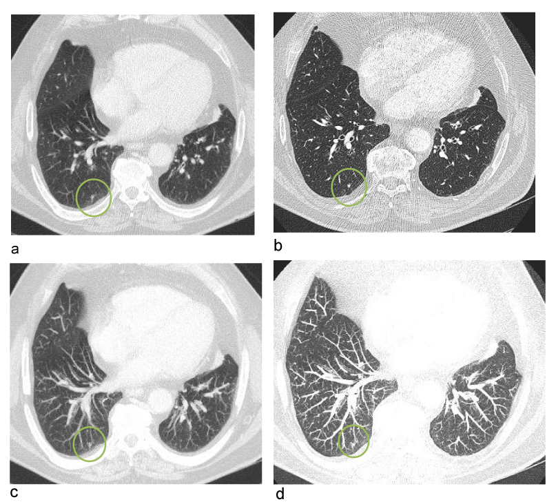 Detection of potentially clinically relevant lung nodules with breath ...