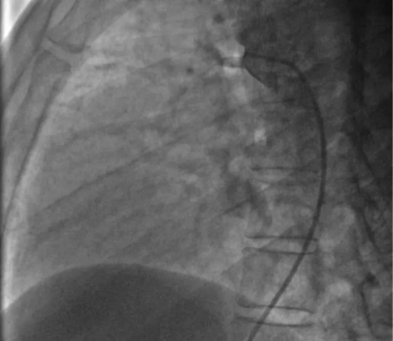Percutaneous Patent Ductus Arteriosus (PDA) closure When and how to